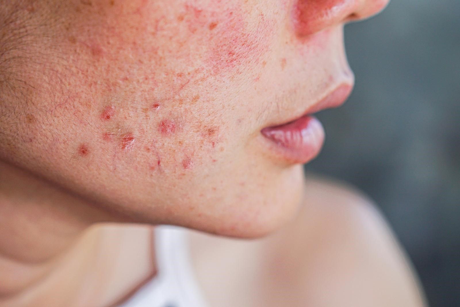 Acne Treatment Tips for Tourists in Dubai: Your Complete Guide