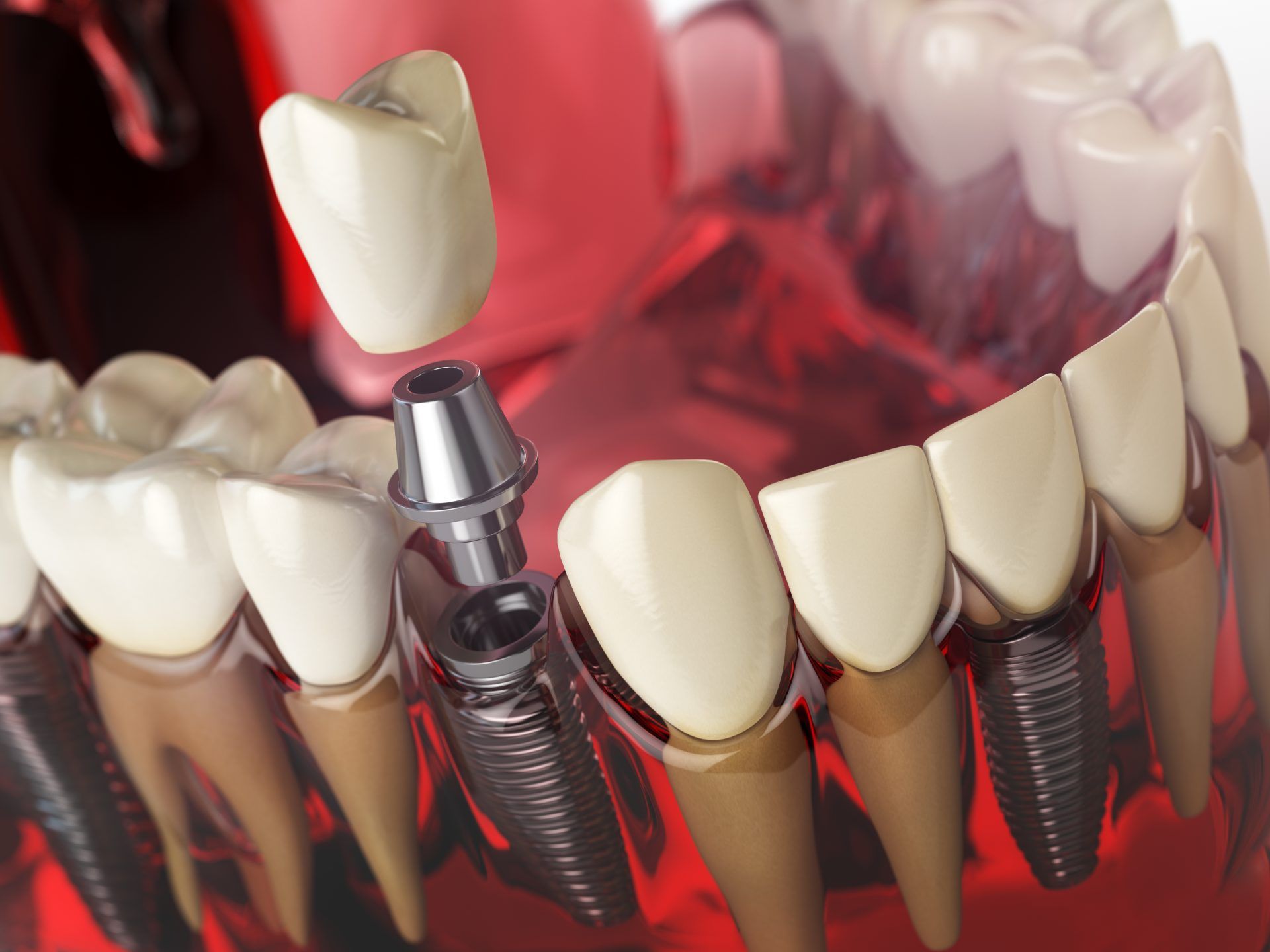 Dental Implants: Stability You Can Trust in Dubai:Single Tooth Implant