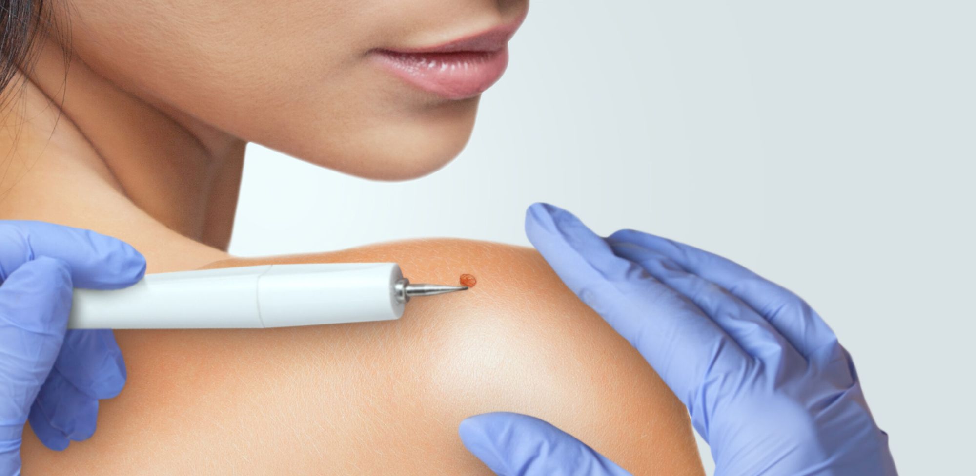 Skin Tag Recovery Tips in Dubai