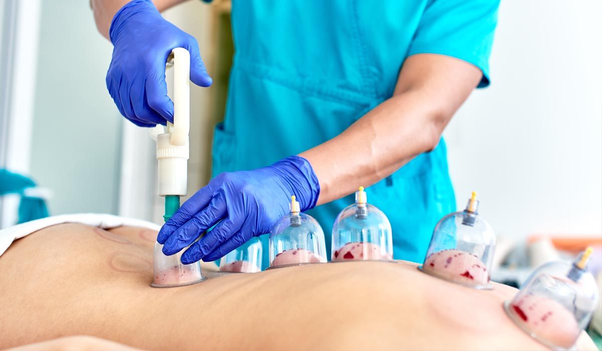 What Is Hijama Cupping Therapy in Dubai All About?