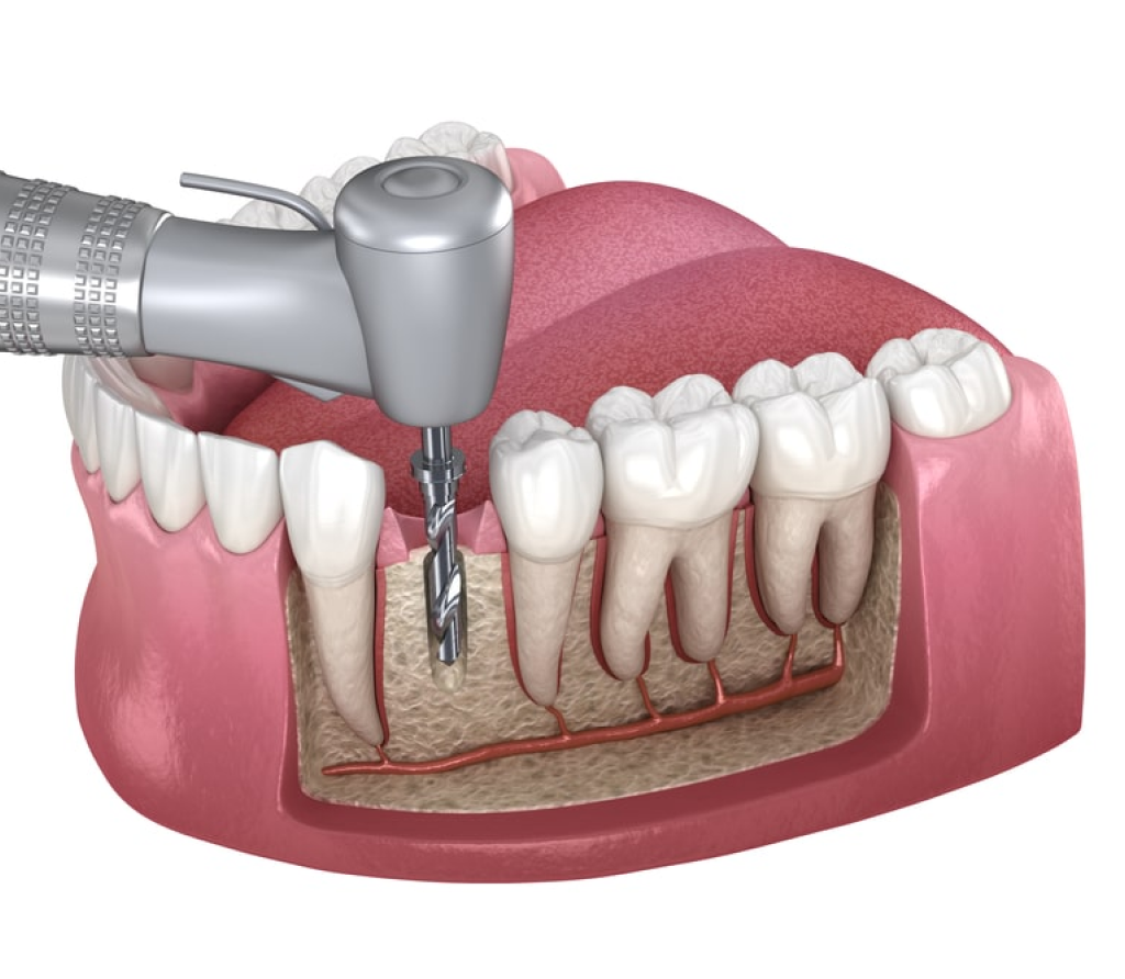 How Root Canal Treatment Relieves Pain