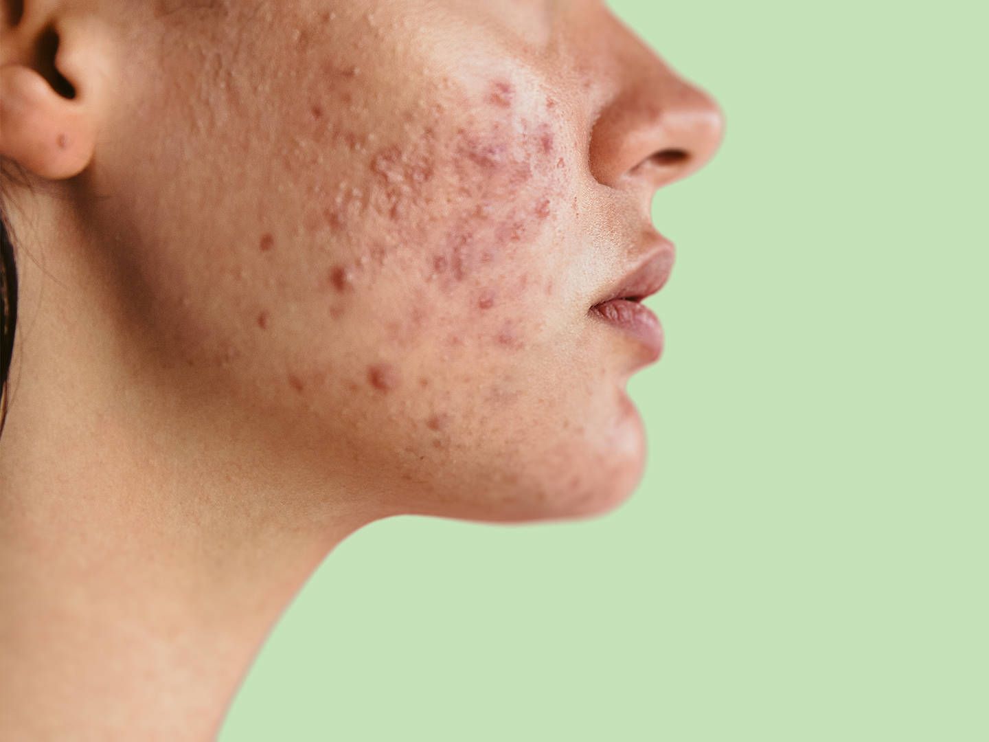 When to Combine Treatments in Acne Treatment Dubai?