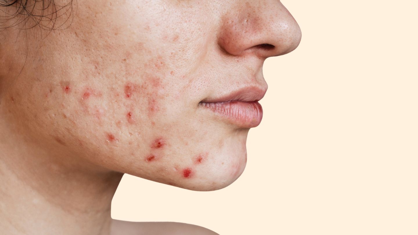 Tailored Skincare: Acne Treatment in Dubai
