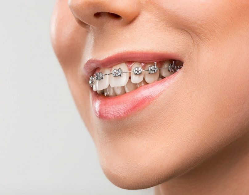 How to Understand Teeth Braces Costs in Dubai Breakdown?