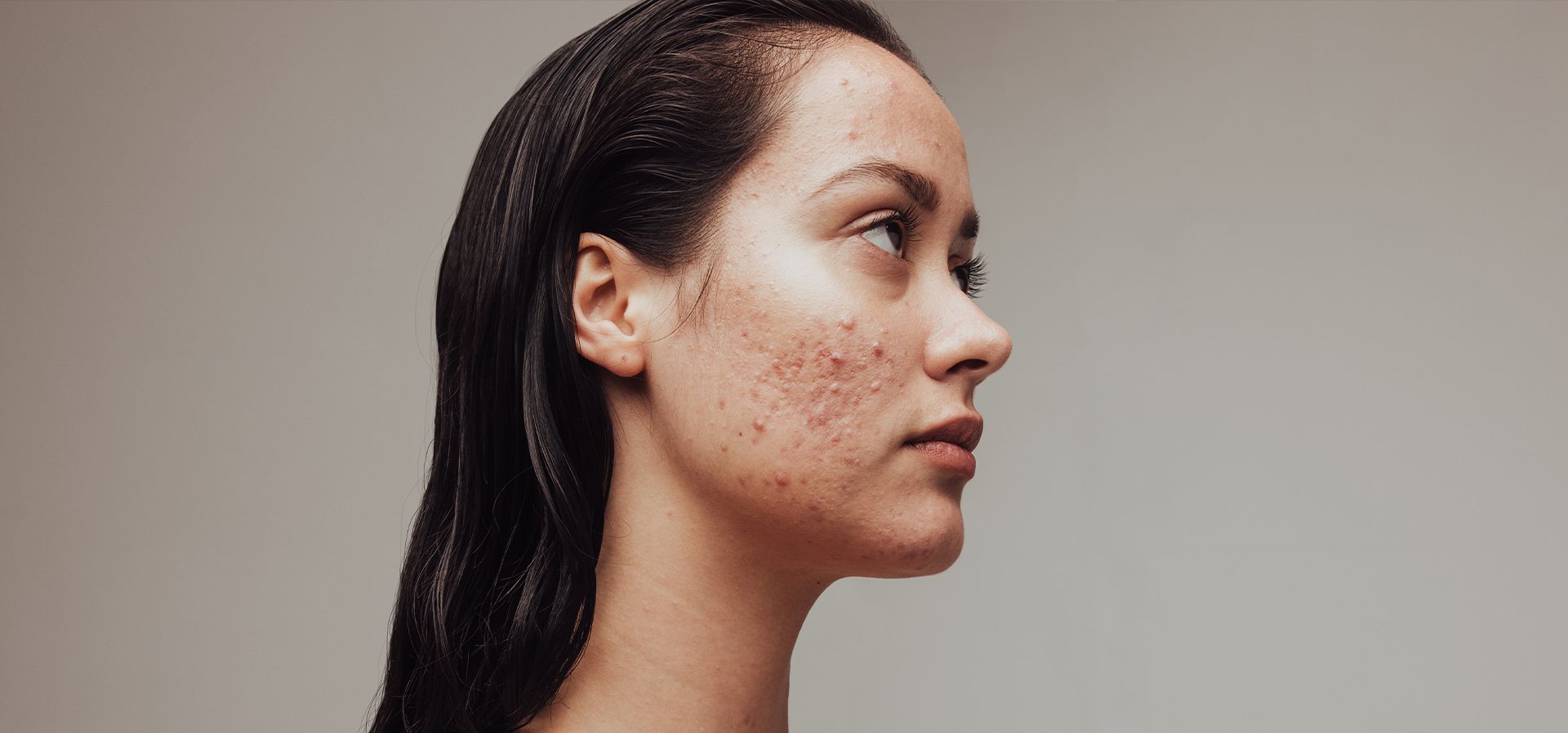 Why Are Lasers Popular in Acne Treatment Dubai?