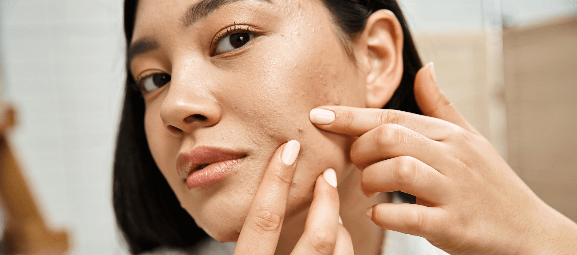 Why Are Lasers Popular in Acne Treatment Dubai?