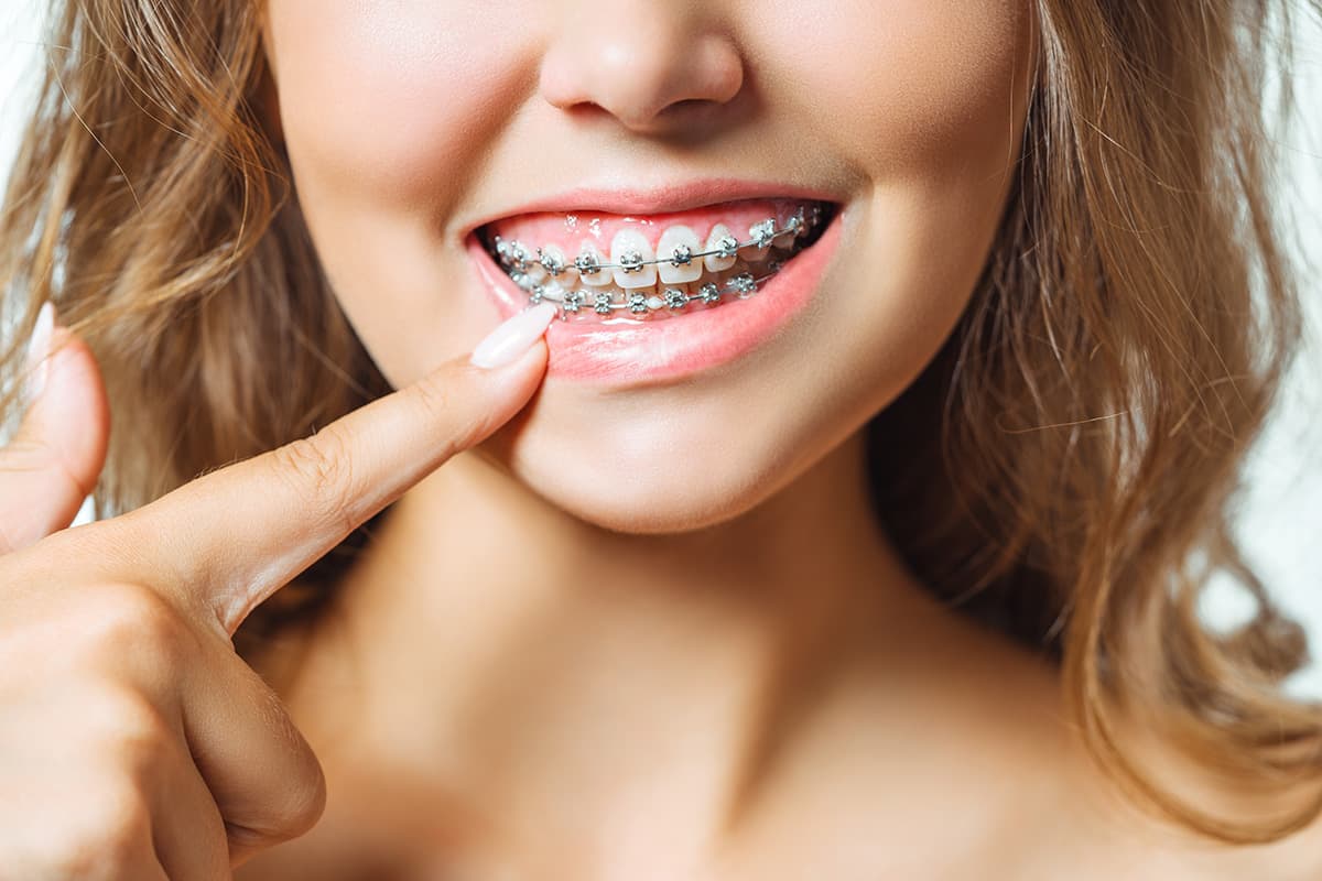 Key Things Impacting Teeth Braces Costs in Dubai