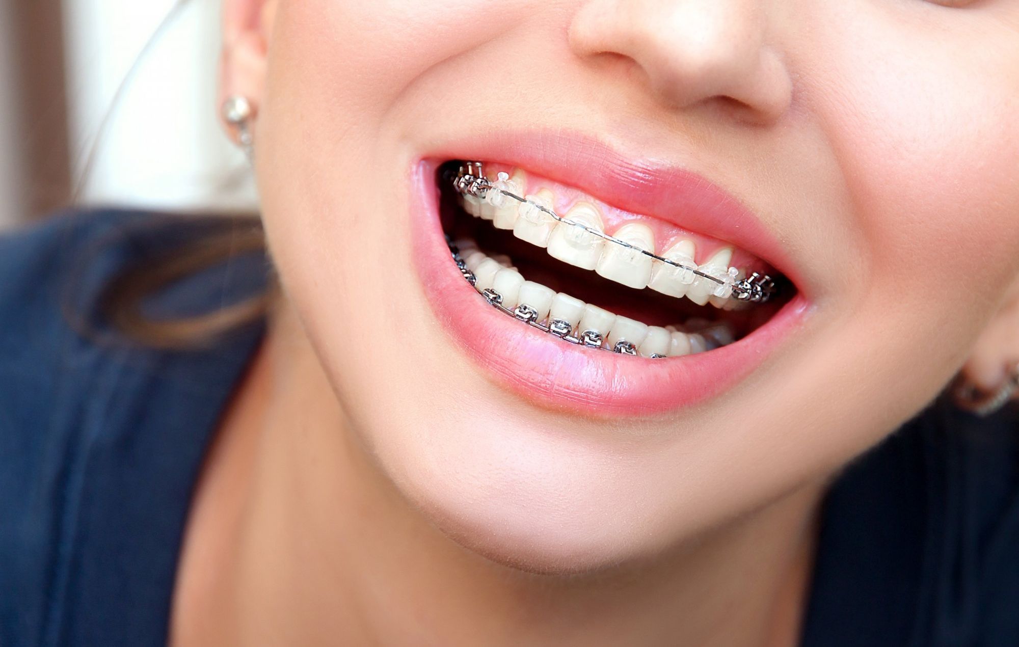 Key Things Impacting Teeth Braces Costs in Dubai