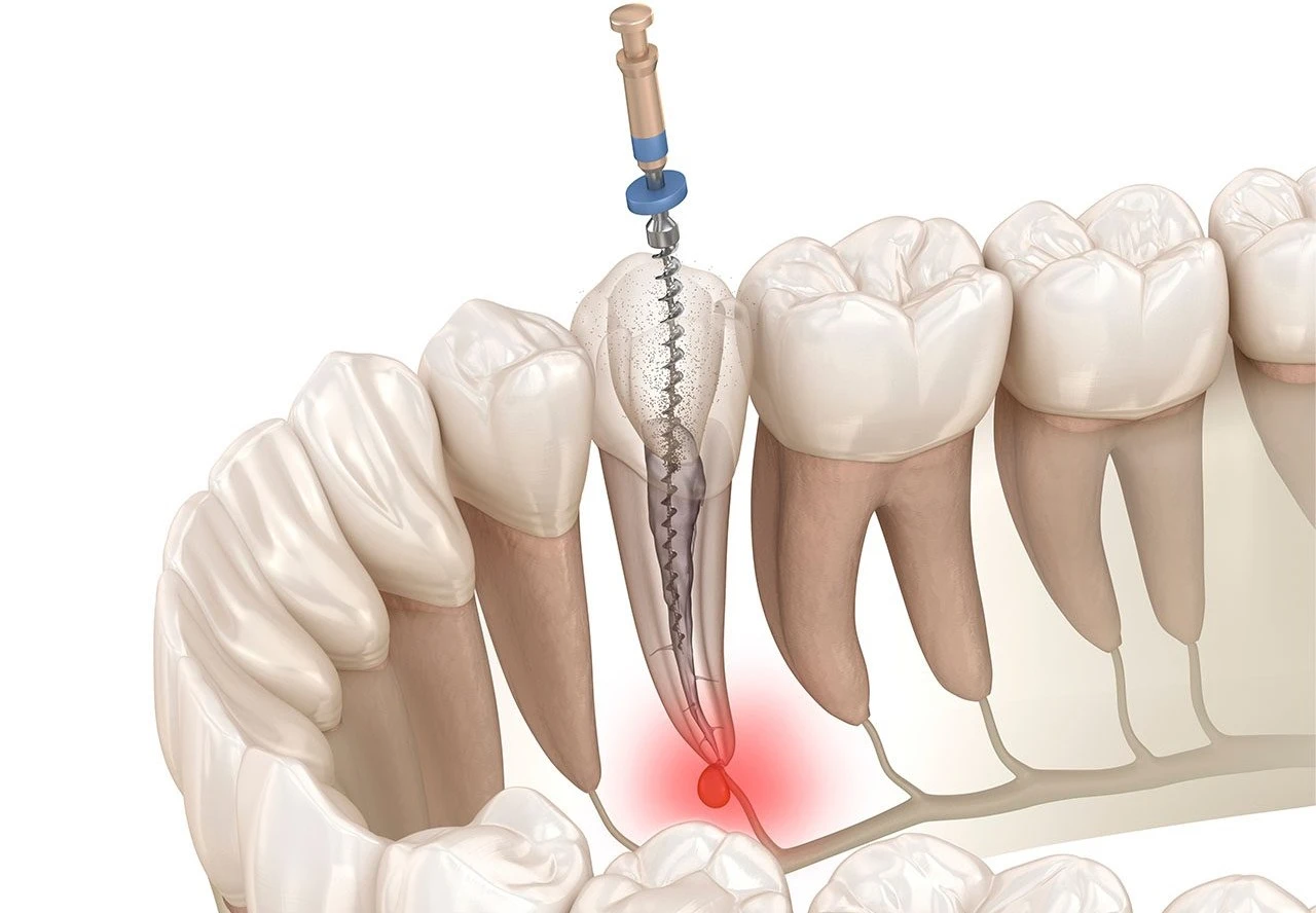 What are the Benefits of Root Canal Treatment in Dubai?