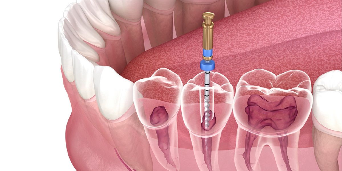 When Can You Return to Work After Root Canal Treatment in Dubai?