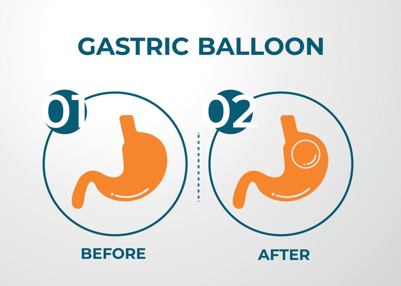 Who Inspires Others with Gastric Balloon Placement in Dubai?