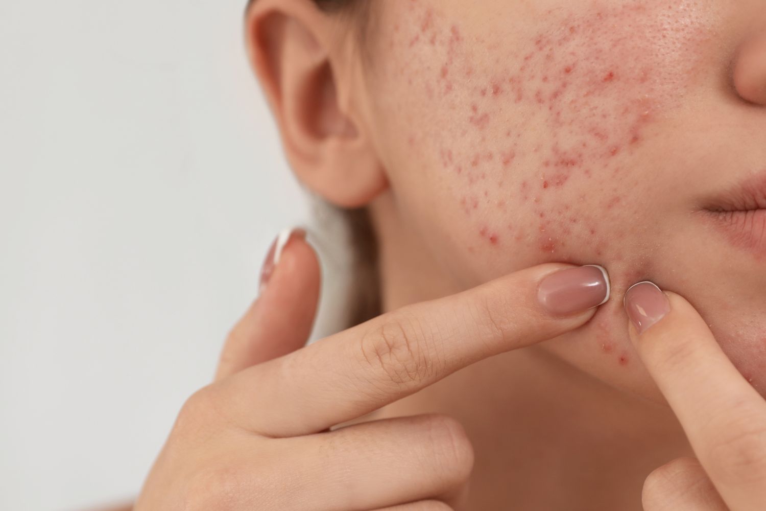 When Is the Ideal Age for Brad Pitt’s Acne Scar Treatment in Dubai?