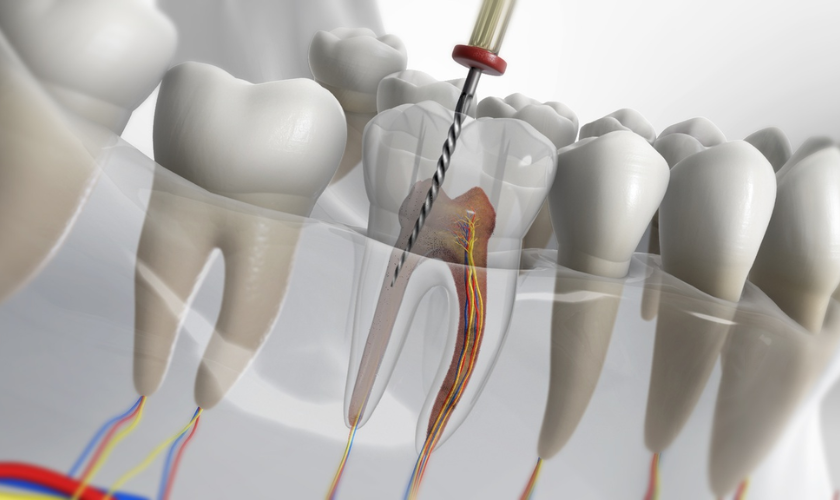 When Is Root Canal More Effective?