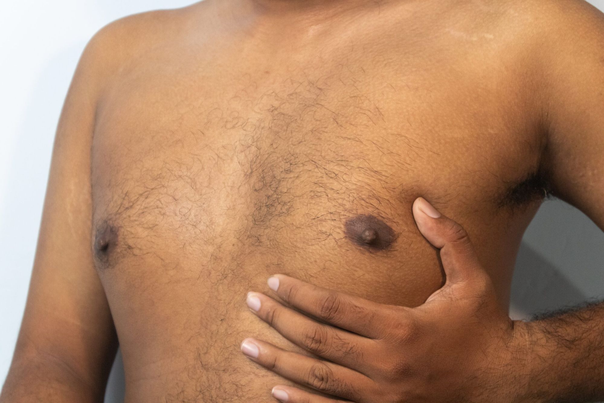What Patients Need Before Gynecomastia Surgery Cost In Dubai?