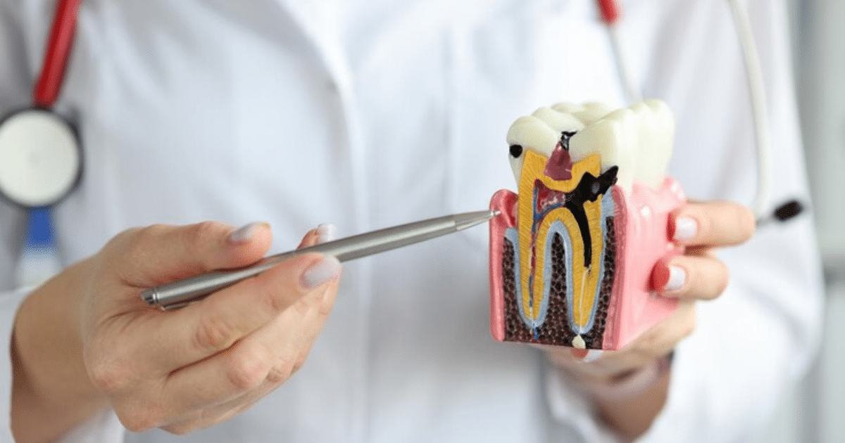 What To Expect From Root Canal Treatment in Dubai?