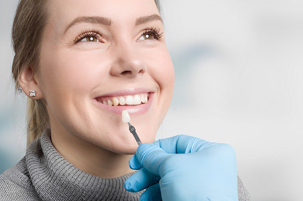 What to Expect From Composite Veneers in Dubai