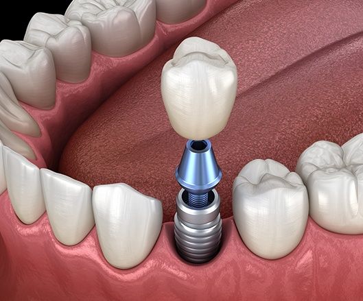 Single Tooth Implant Price Expectations Guide