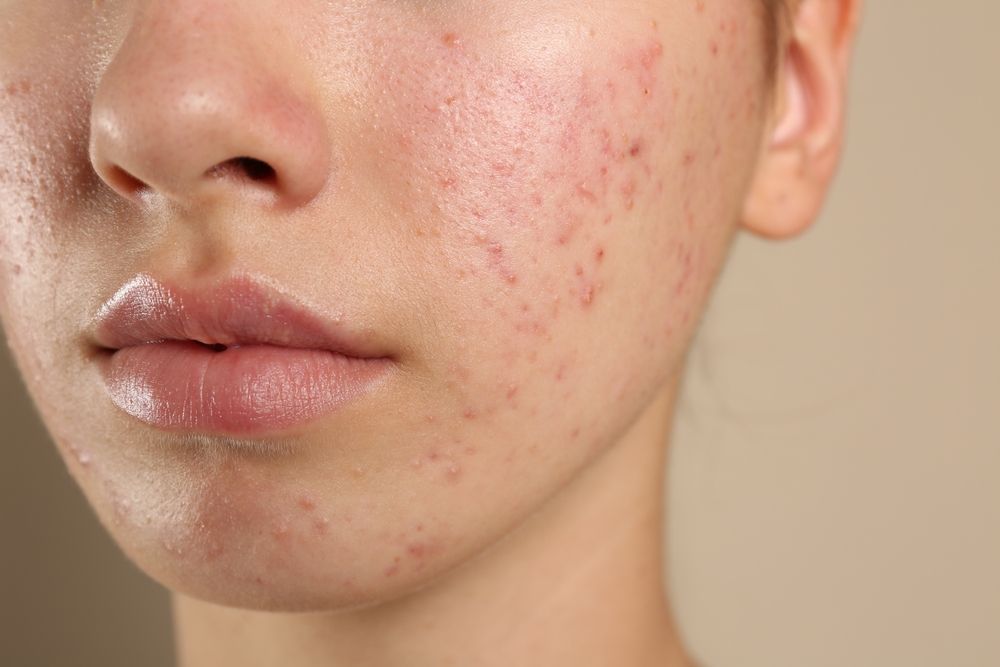 What to Know Before Acne Treatment