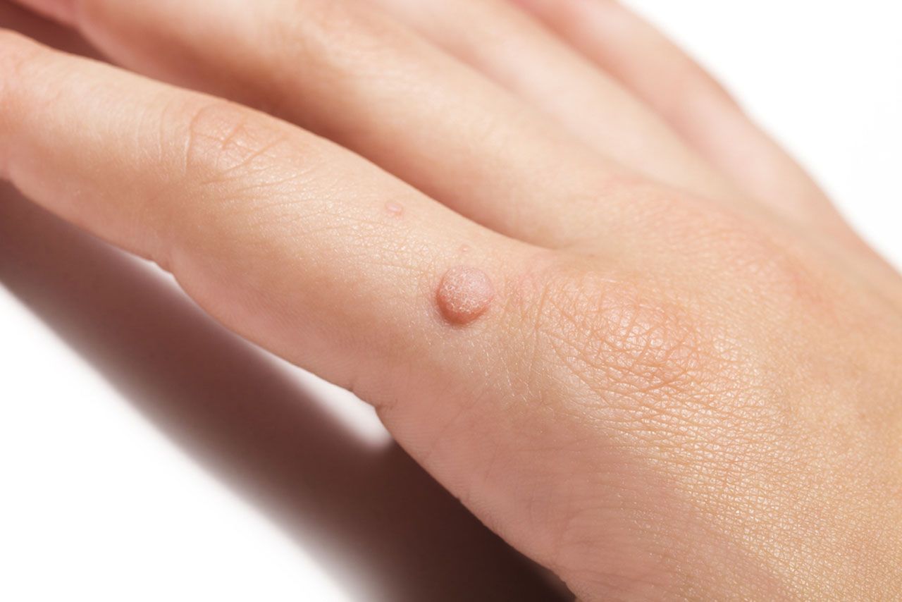 What Are Dubai’s Average Prices for Skin Wart Removal?
