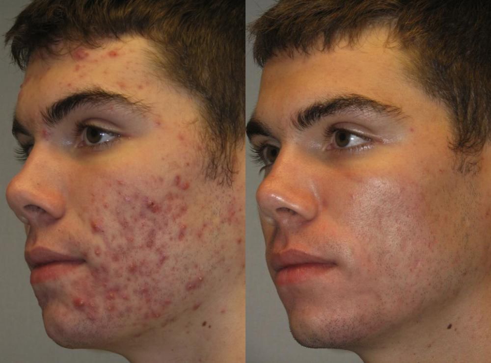 Why Is Pimples Treatment in Dubai Effective?