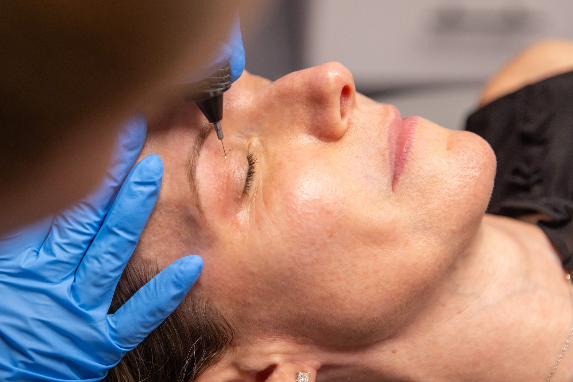 What Is Plasma Pen Treatment in Dubai Used For?