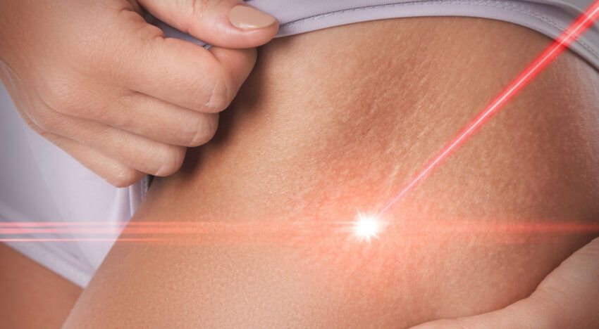 What Makes Scar Camouflage in Dubai Popular