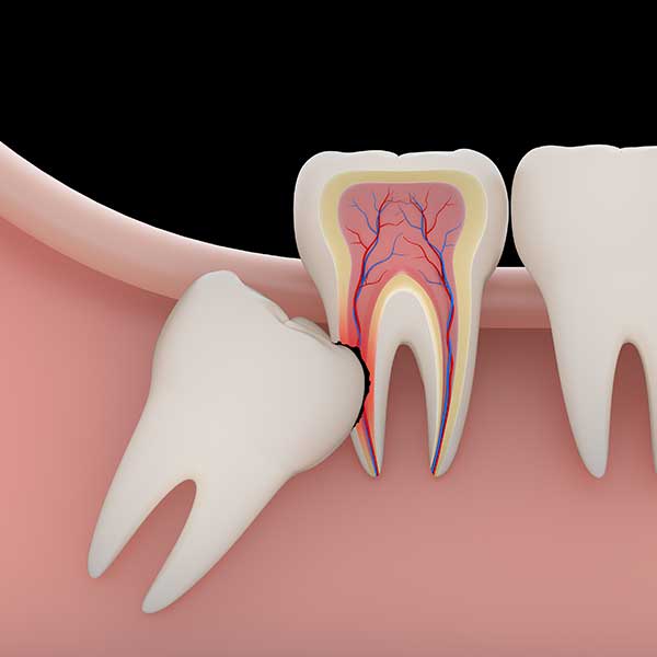 Why Gum Pain Needs Wisdom Tooth Extraction