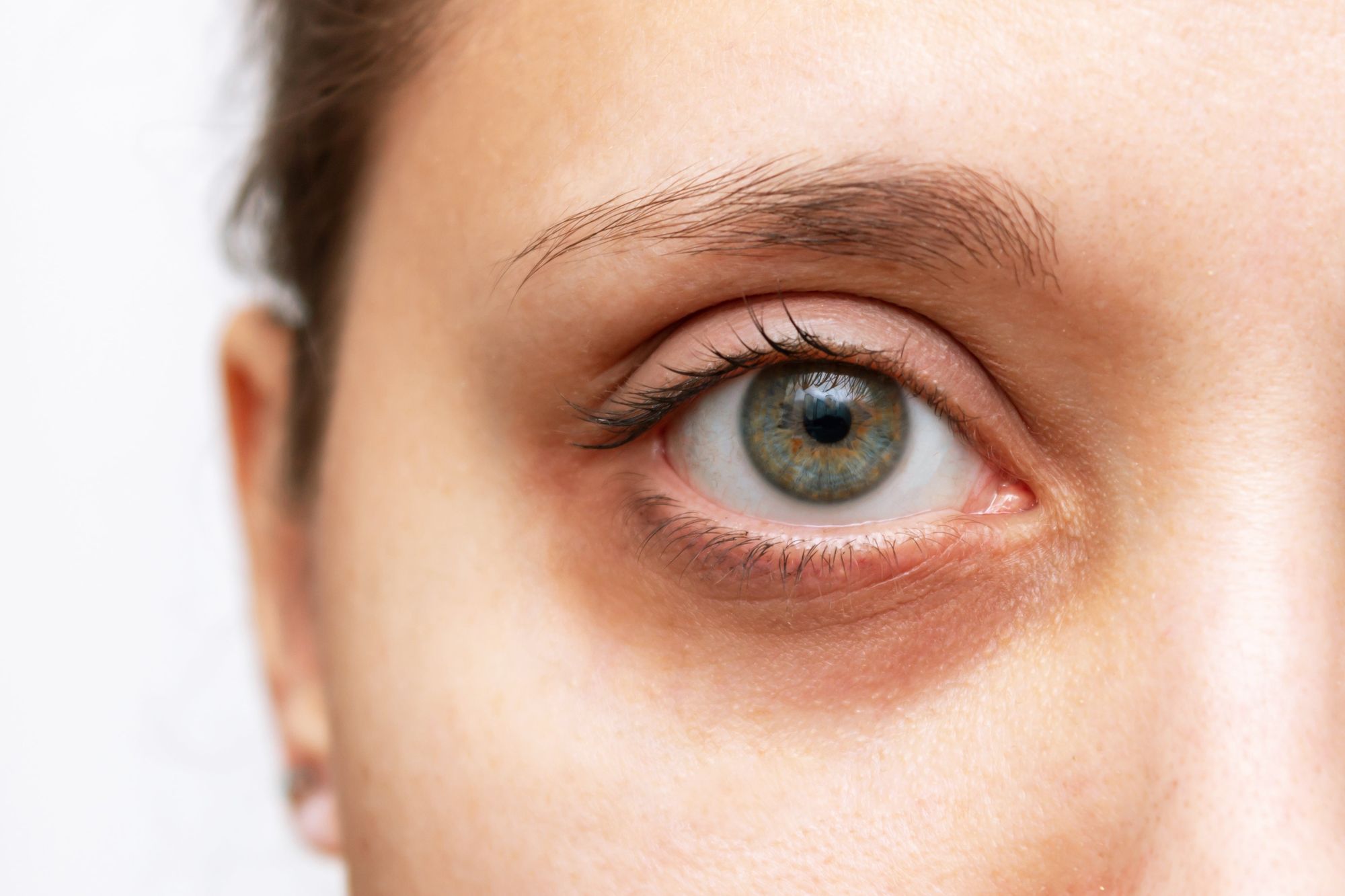 How to prepare Dark circles treatment in Dubai