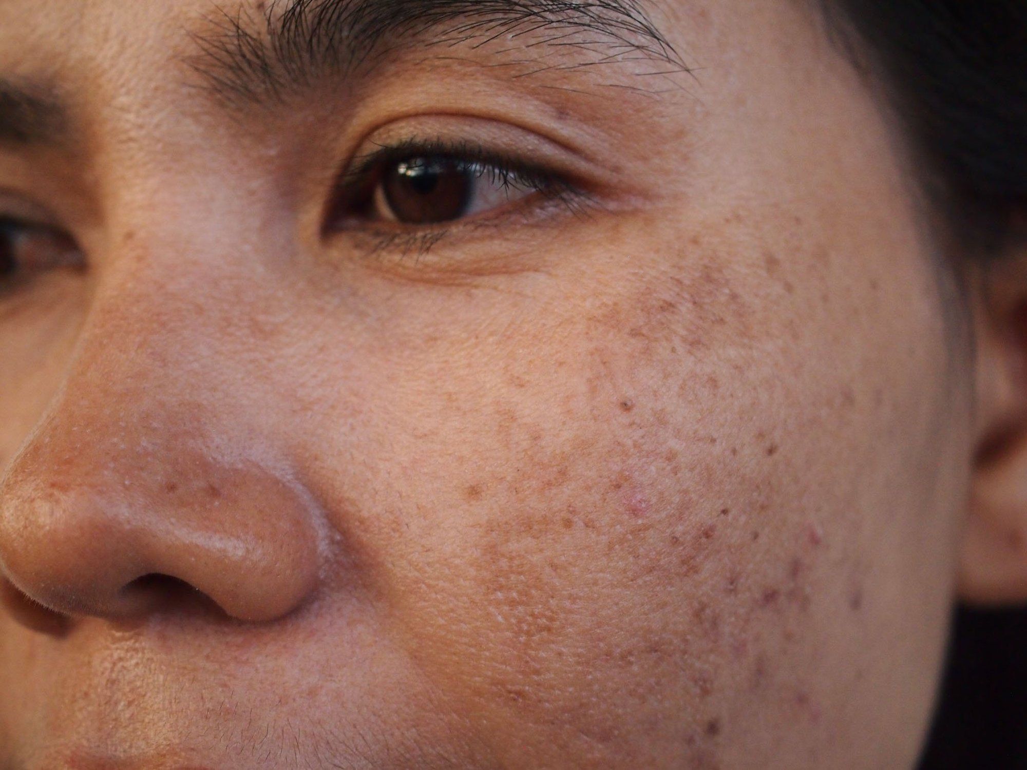 Why Use Pigmentation Treatment in Dubai