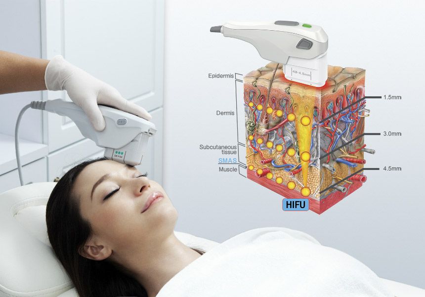 What Areas of the Body Can Be Treated with HIFU