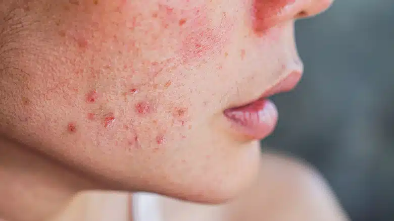 Average Cost of Dermatologist pimple Treatment in Dubai