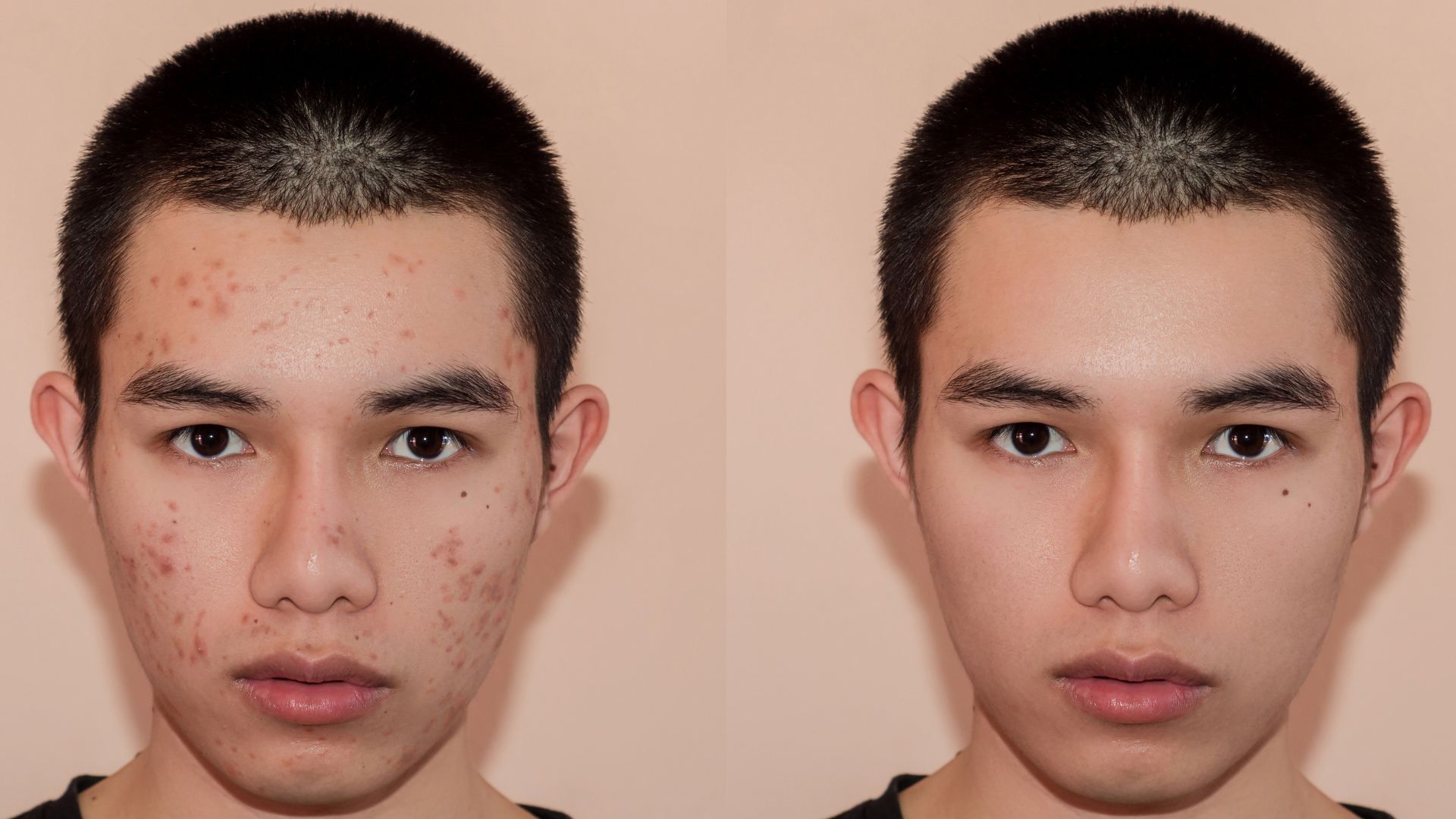 What Results Come From Pimples Treatment in Dubai?