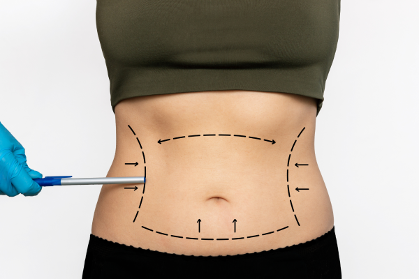 Why Choose Plastic Surgery Tummy Tuck Dubai?