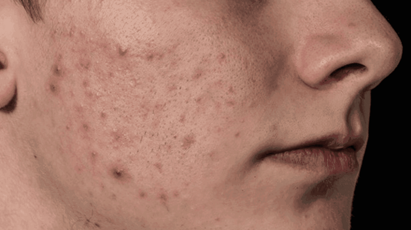 When Should You Consider Professional Acne Care?