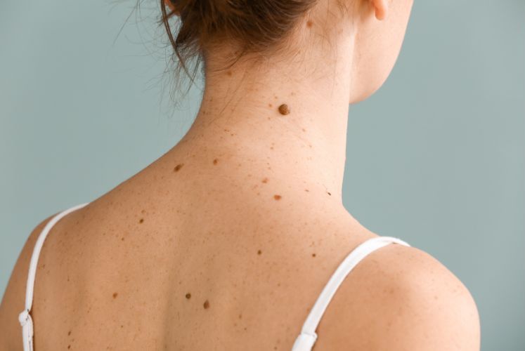 Why Search for Mole Removal Information Online?