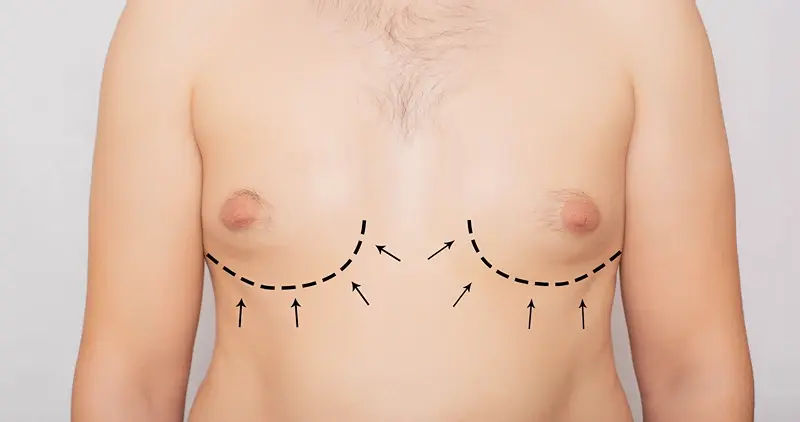 When Is Gyno Surgery Dubai Recommended?